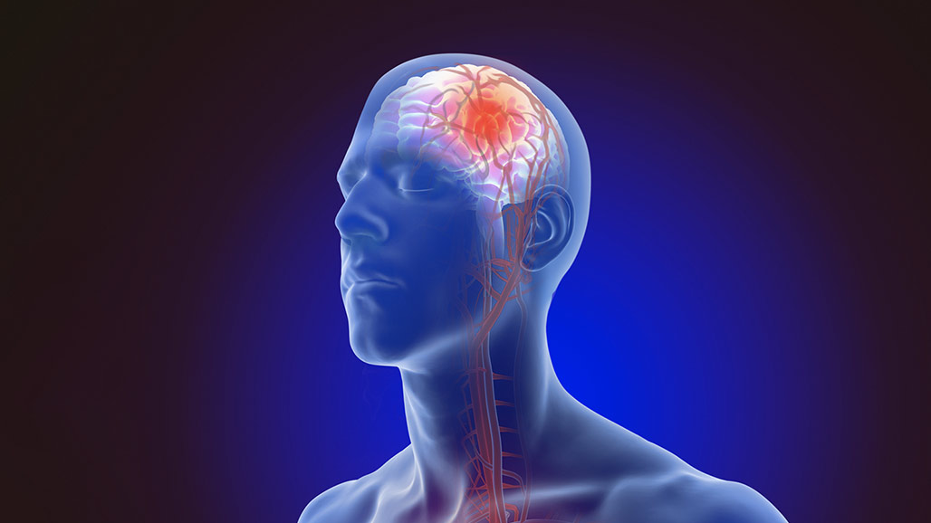 Stroke: The Silent Killer